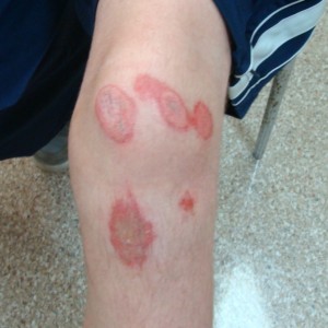 Ryan's knee