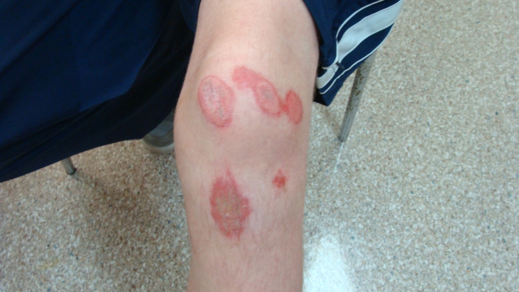 Ryan's knee